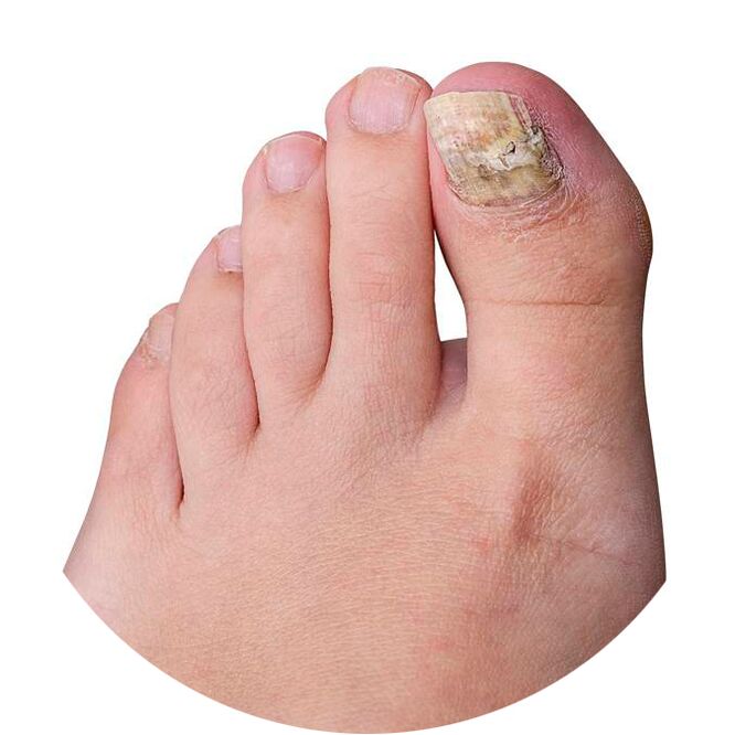 Promicil Cream for Fungal Infection on Toes