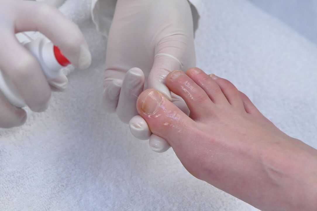 Fungal treatment