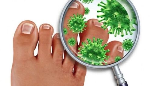 Nail fungus