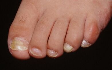 The reasons for the appearance of the fungus on the thumb