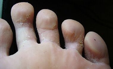 How do you see the fungus on your legs and how to treat it