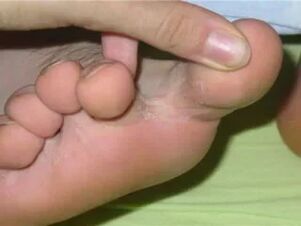 Finging itching