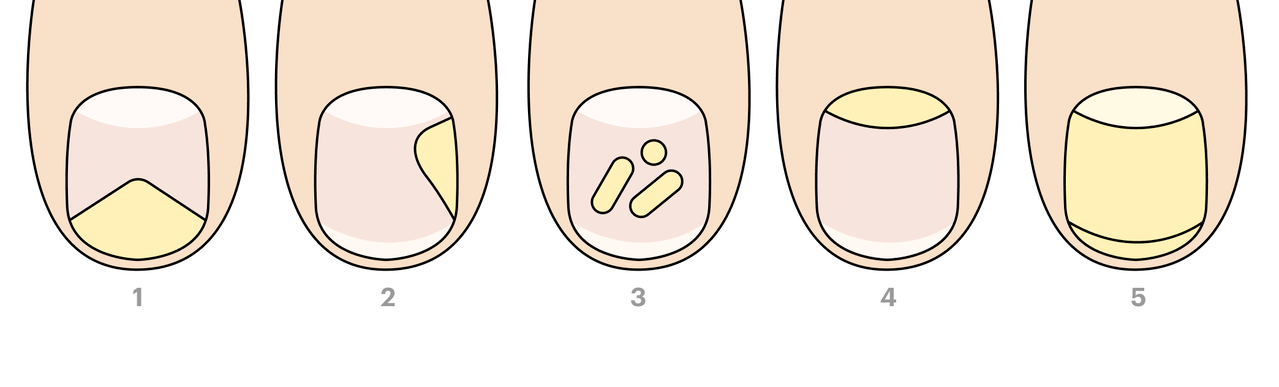 types of toenail fungus