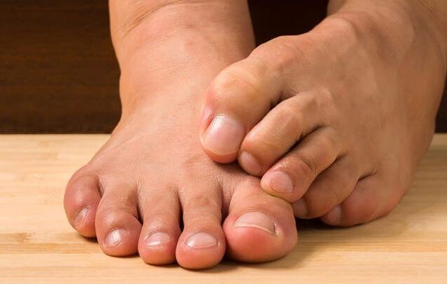 Foot fungus and remedies for its treatment.