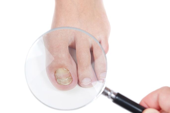 A nail affected by fungus under a magnifying glass. 