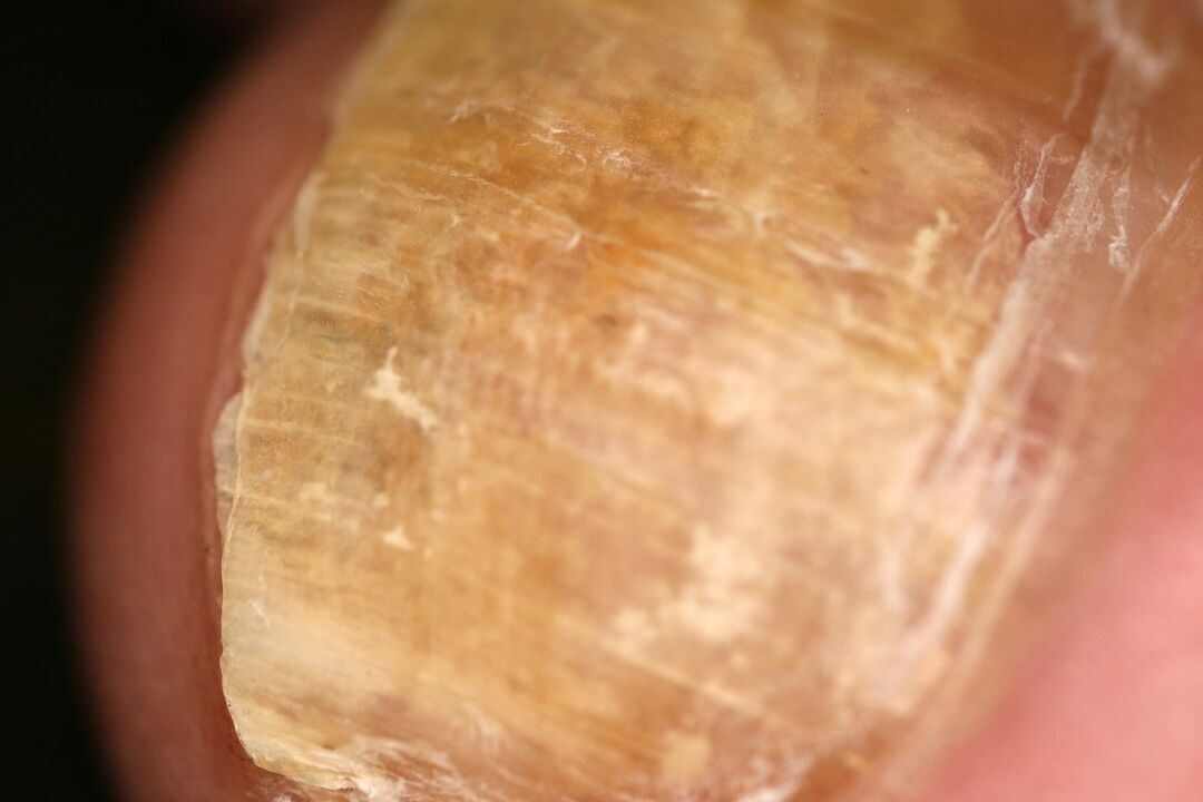 Appearance of a nail plate affected by fungi. 