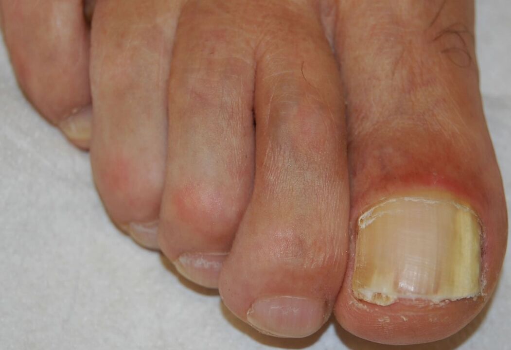 Distal-lateral subungual onychomycosis in the leg